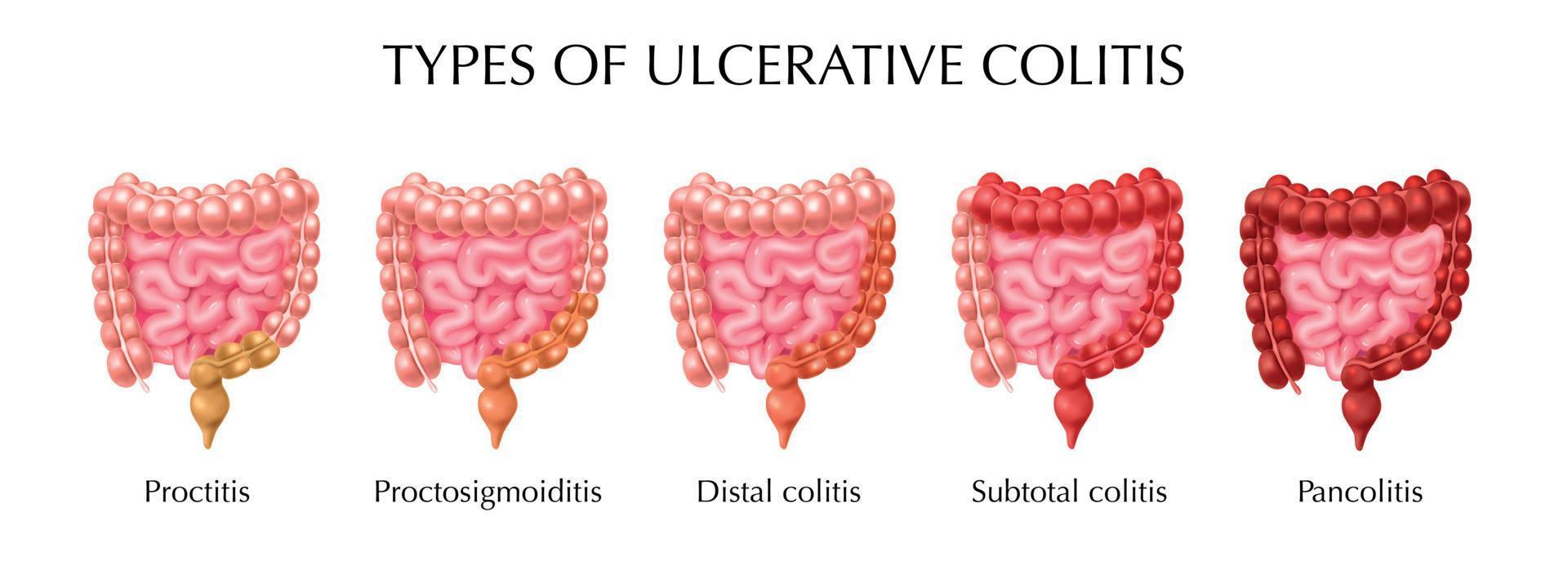 infográficos de tipos de colite ulcerativa vetor