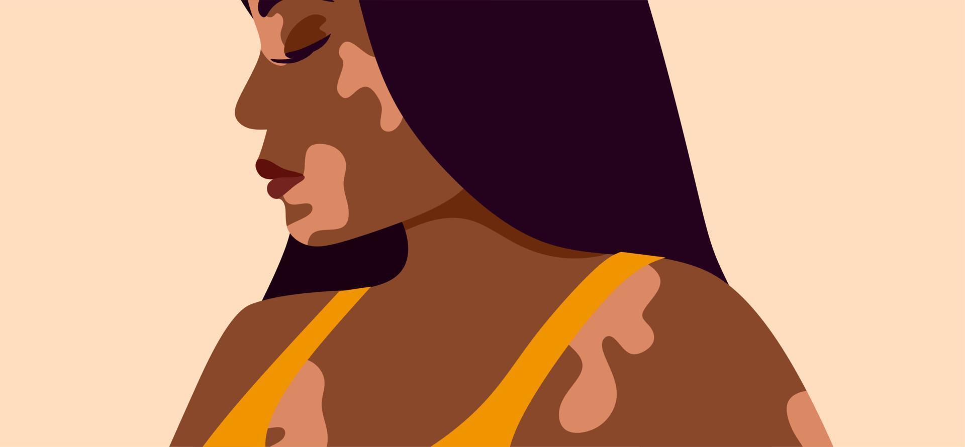 vitiligo é uma jovem morena com problemas de pele. doenças de pele. o conceito de dia mundial do vitiligo. diferentes cores de pele de personagens femininas. para um blog, artigos vetor