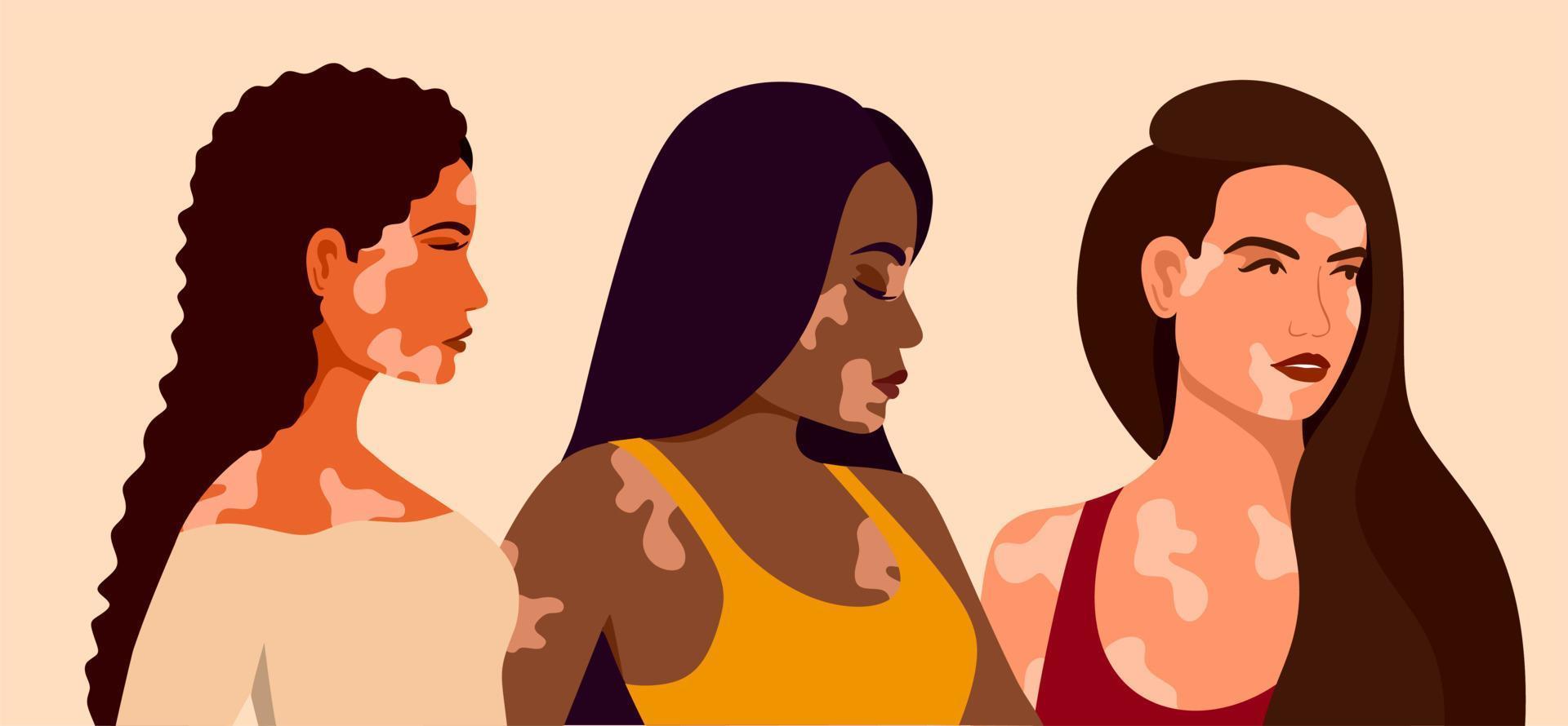 vitiligo três jovens de diferentes raças com problemas de pele. doenças de pele. o conceito de dia mundial do vitiligo. diferentes cores de pele de personagens femininas. para um blog, artigos, banner, revista. vetor