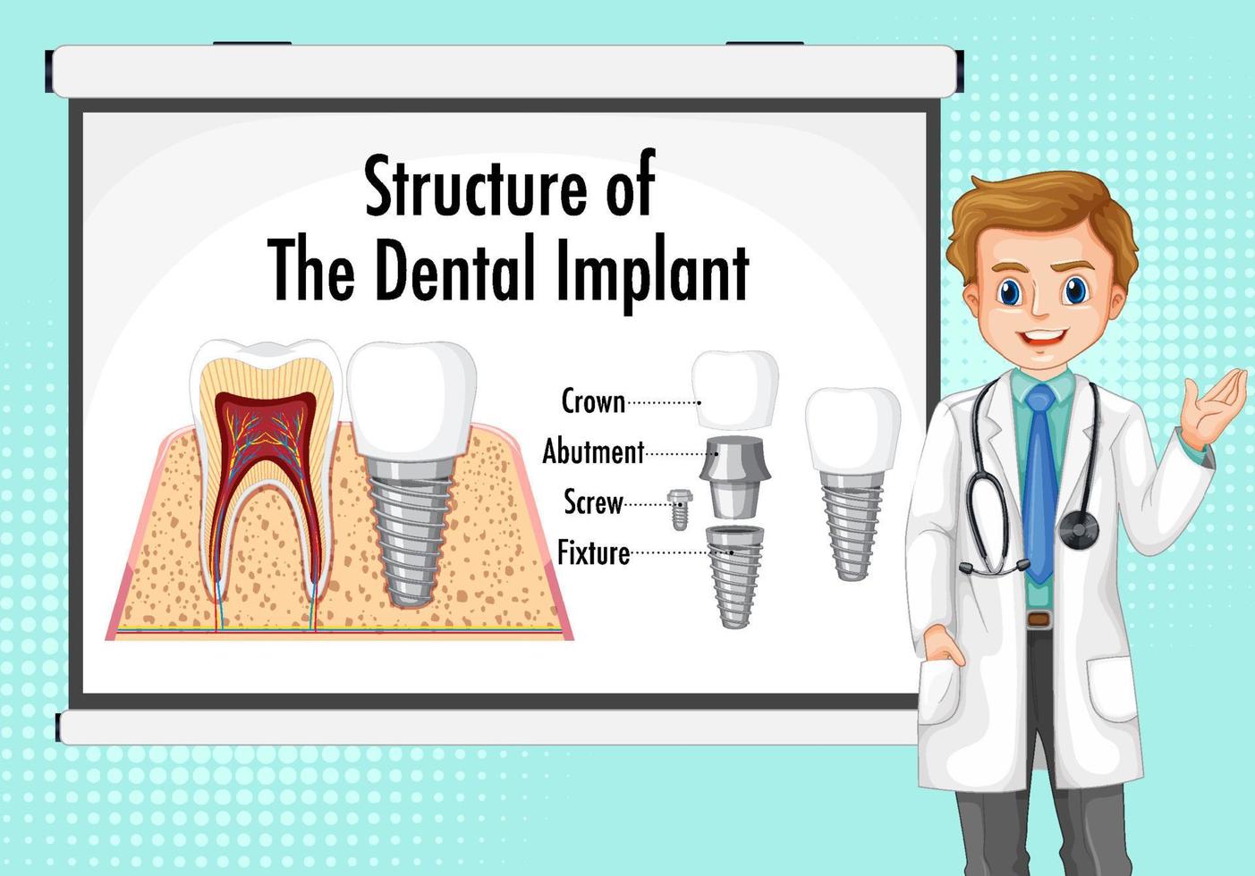 infográfico de humano na estrutura do implante dentário vetor