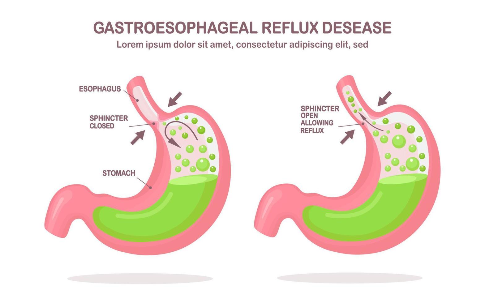 estômago humano. doença do refluxo gastroesofágico. gerd, azia, infográfico gástrico. ácido subindo para o esôfago. design plano de vetor