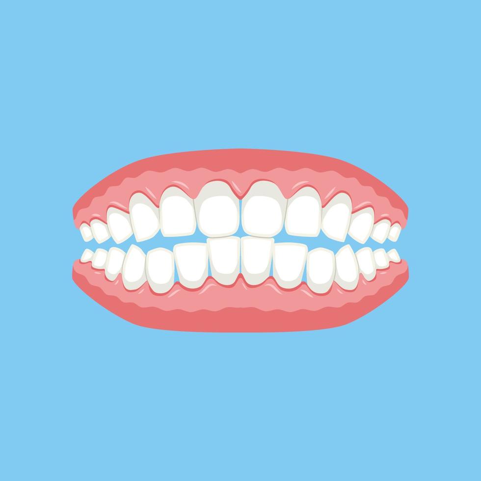 dentadura, gengivas com dentes ou dentaduras. . ilustração vetorial. vetor