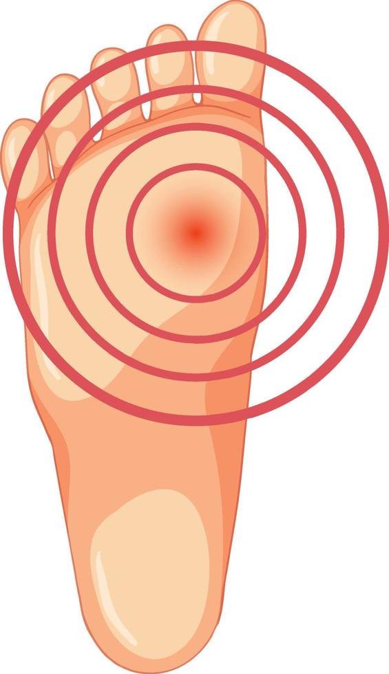 tipos de hallux valgus em fundo branco vetor