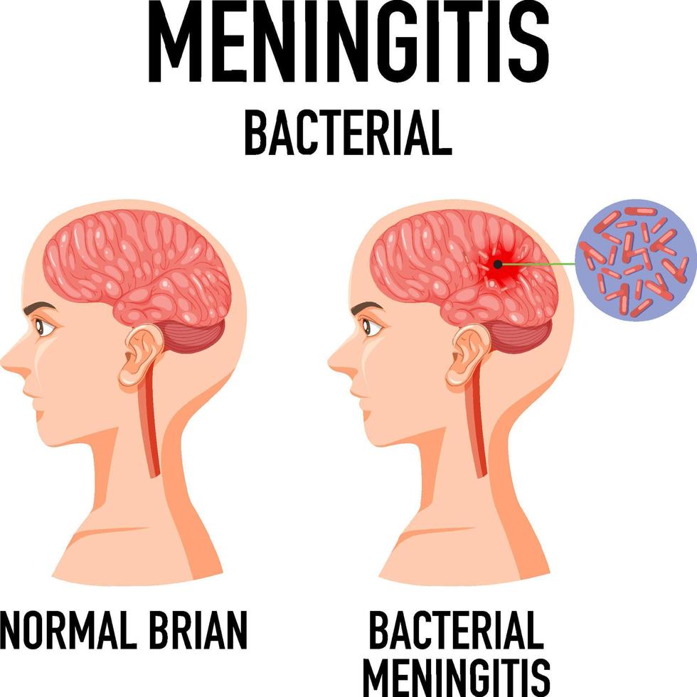 diagrama mostrando meningite bacteriana no cérebro vetor