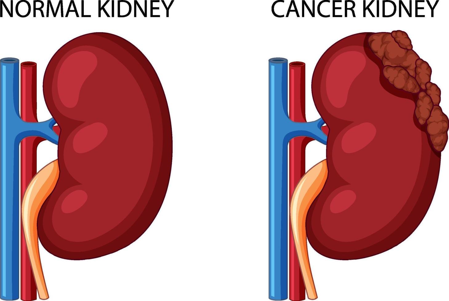 rim normal e rim canceroso vetor