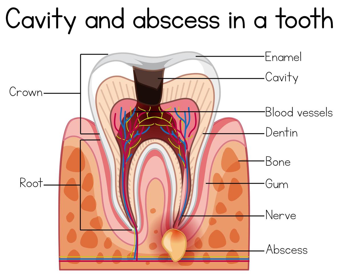 Cavidade e abscesso no dente vetor