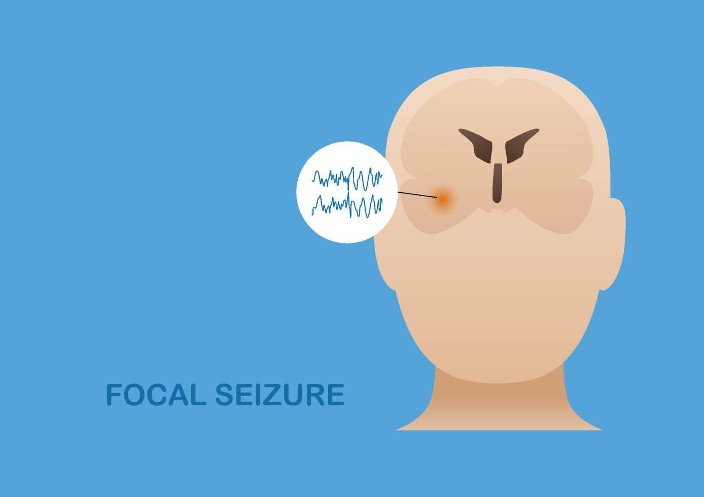 convulsão focal do lobo temporal vetor