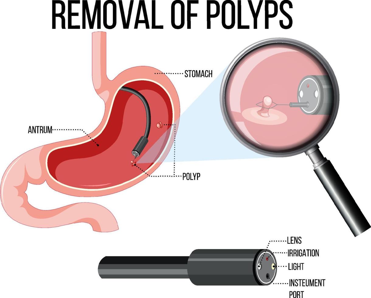 diagrama mostrando a remoção de pólipos vetor