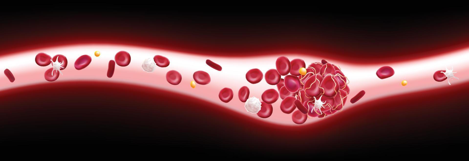 Ilustração 3D de um coágulo de sangue em um vaso sanguíneo mostrando um fluxo sanguíneo bloqueado com plaquetas e glóbulos brancos na imagem. vetor