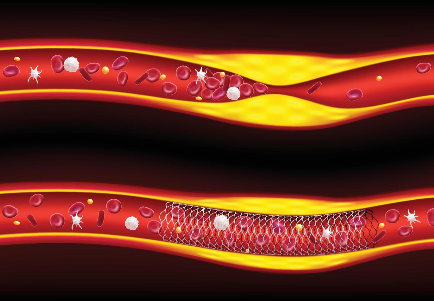 Ilustrações 3D antes e depois do stent melhoram o fluxo sanguíneo, aterosclerose. vetor