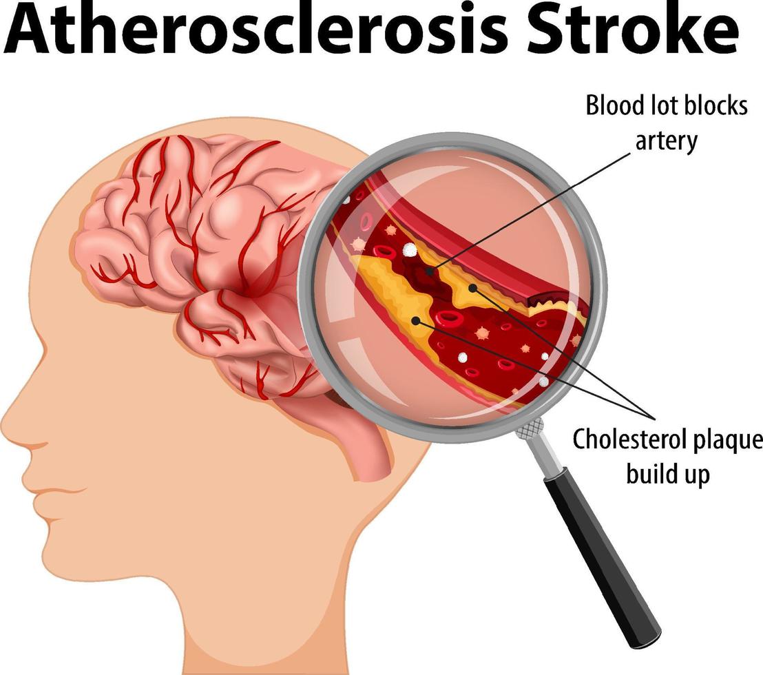 anatomia humana com acidente vascular cerebral de aterosclerose vetor