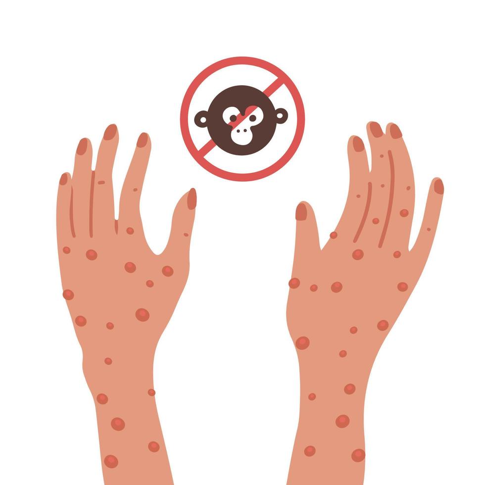 duas mãos com erupções do vírus da varíola dos macacos. parar nova infecção. ilustração em vetor plana isolada.