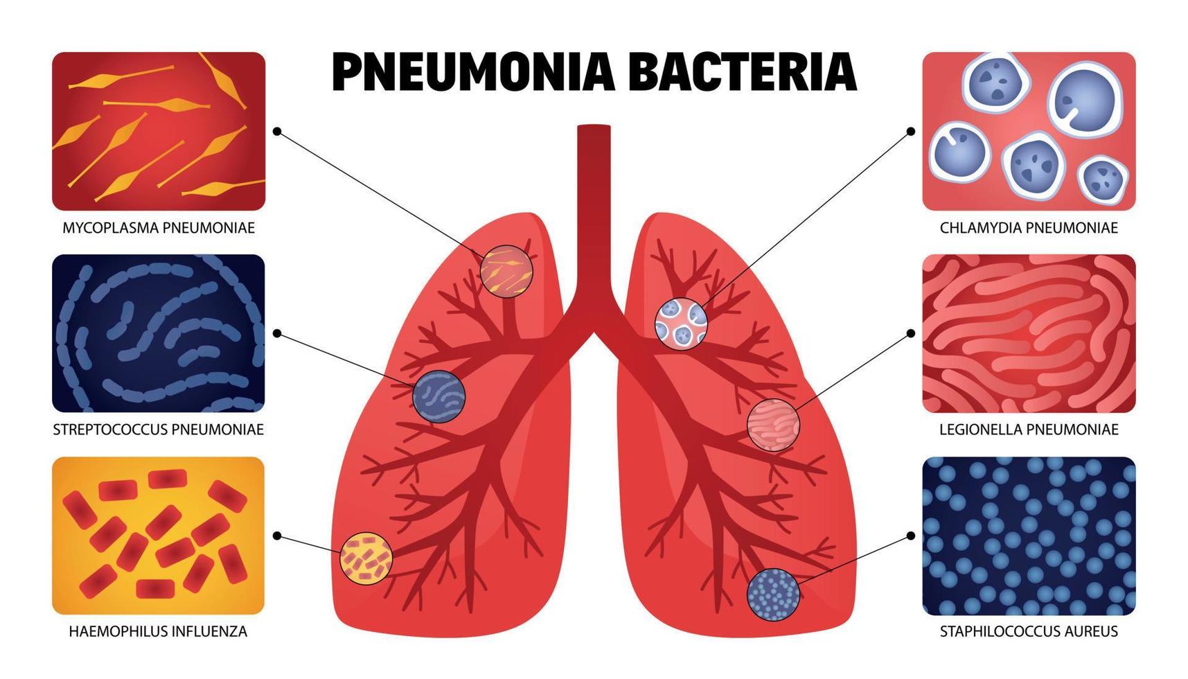 coleção de pulmões de bactérias de pneumonia vetor