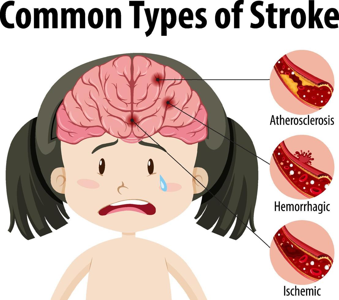 humano com tipos comuns de acidente vascular cerebral vetor