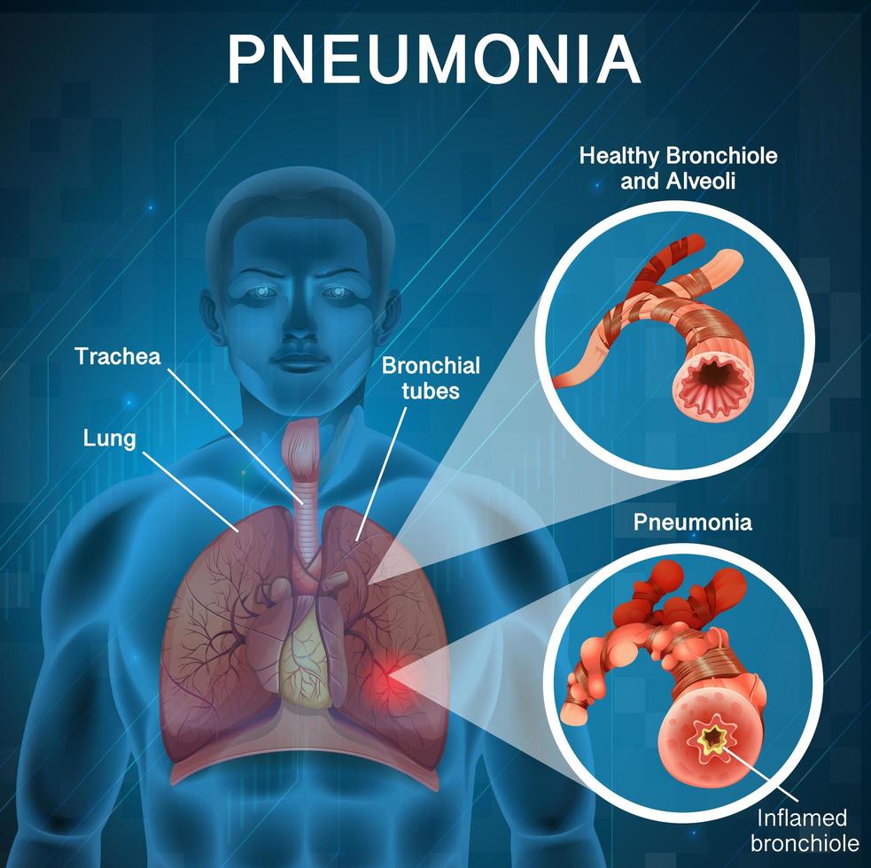 design de cartaz para pneumonia vetor