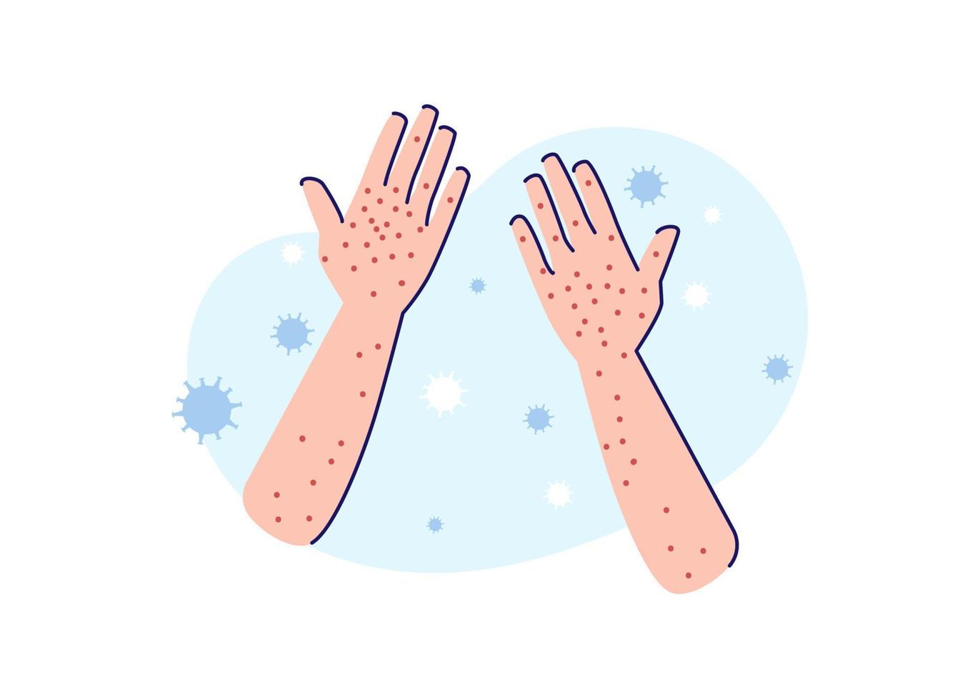 Monkeypox ou varíola de macaco sintomas ilustração plana vetor isolado. sardas nas mãos devido a sintomas de varicela..