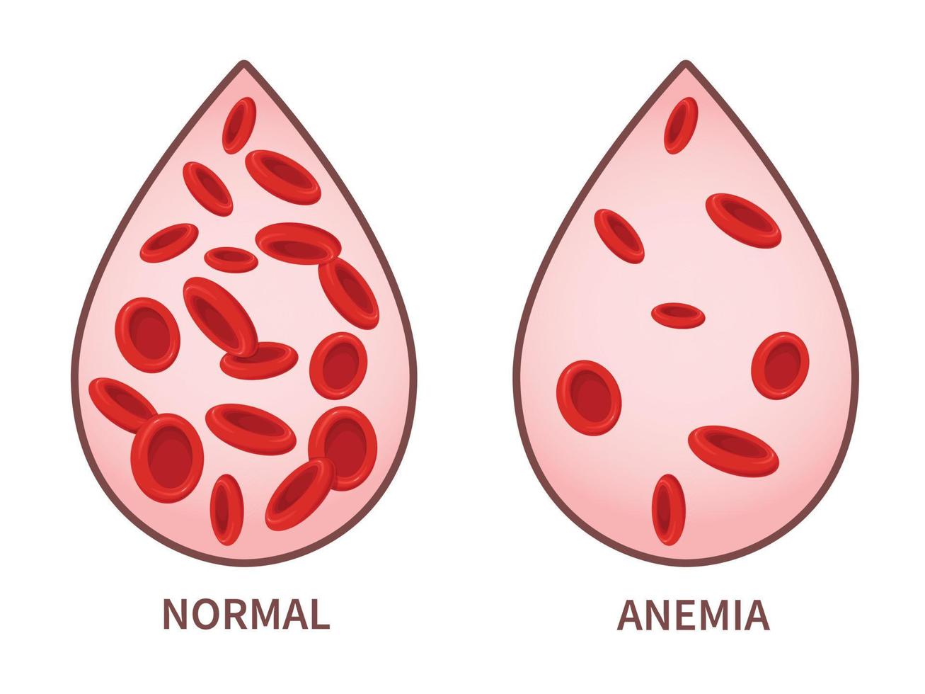 hemoglobina. sintomas de anemia, doença do sangue. conceito de cuidados de saúde. vetor