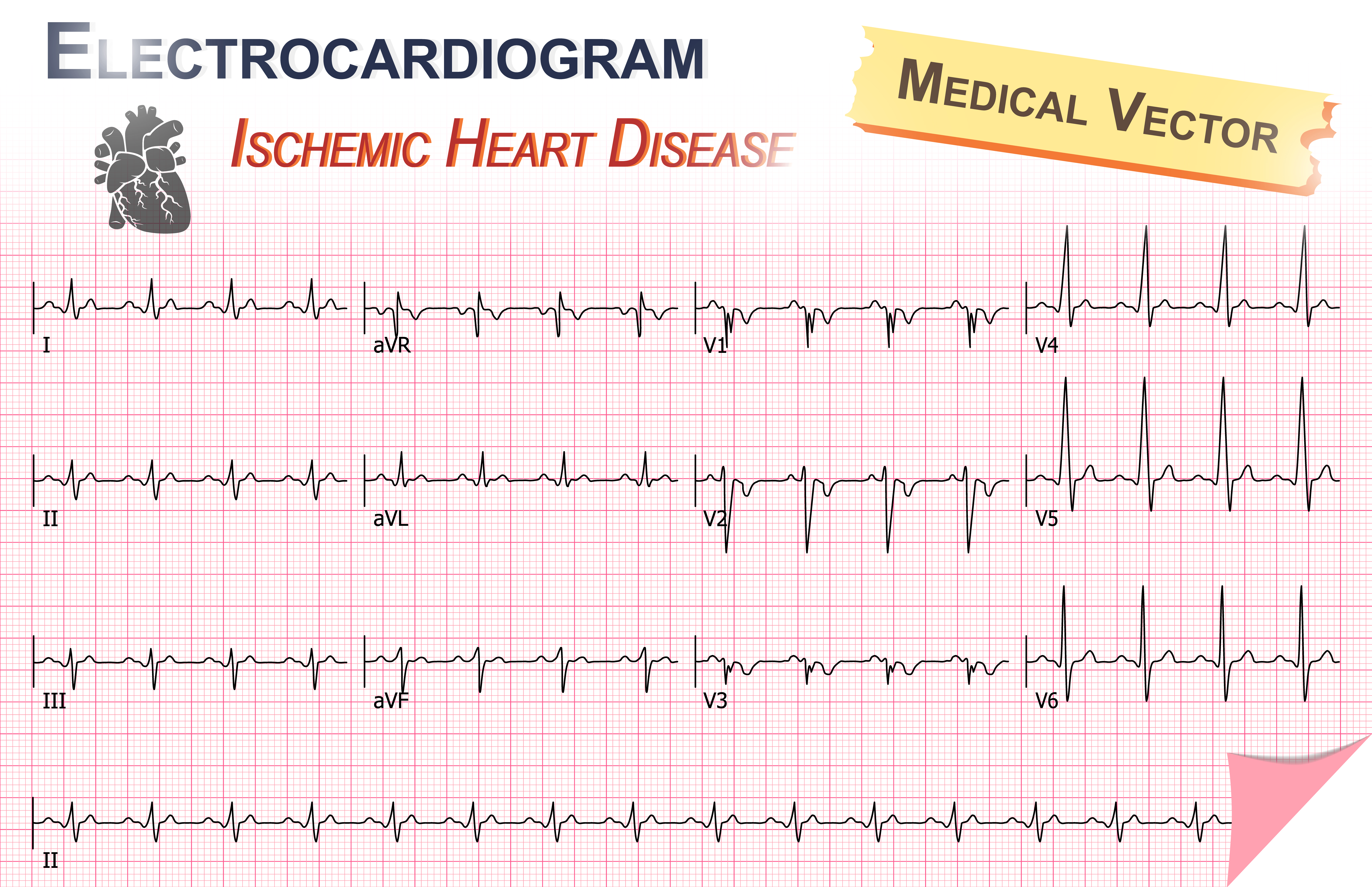 Infarto do Miocárdio visto pelo Cardiograma Vetorial e Espaço de