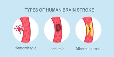 tipos de acidente vascular cerebral humano. doença isquêmica, aterosclerose e acidente vascular cerebral hemorrágico vetor