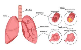 enfisema dos pulmões. Doença pulmonar. infográficos. ilustração vetorial em estilo cartoon, isolado no fundo branco. vetor