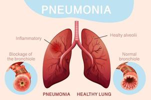 poster para pneumonia com pulmões humanos vetor