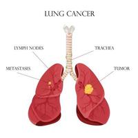 diagrama doença de câncer de pulmão. órgãos internos humanos de doença de conceito. ilustração vetorial, estilo cartoon. vetor