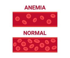 sangue normal e anemia em comparação de vasos, número de células de circulação eritrócitos. hemoglobina baixa, anemia ferropriva. células sanguíneas anêmicas da doença. problema de saúde. ilustração vetorial vetor