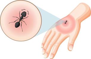 picadas de formiga preta picam na pele vetor