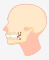 modelo de desenho animado de ilustração plana em vetor de vista lateral da mandíbula dental humana. imagem do crânio com dente do siso empurrando os dentes adjacentes isolados no fundo branco. problema de cirurgia odontológica