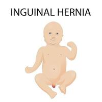 ilustração vetorial de hérnia inguinal em crianças vetor