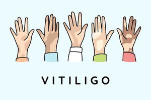 diversas mãos de pessoas sofrem de doença de vitiligo. as pessoas lutam com a pigmentação no corpo. conceito de dia mundial do vitiligo. ilustração vetorial. vetor