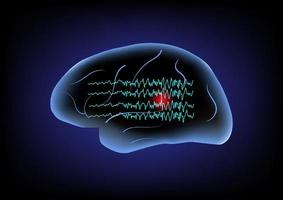 ondas cerebrais anormais e cérebro humano. conceito de crise focal. vetor