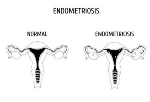 órgãos genitais femininos com e sem contorno de endometriose. infográficos. vetor