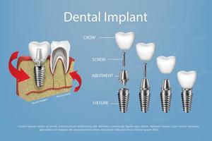 dentes humanos e vetor de implante dentário em maquete de goma.