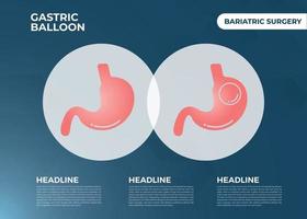 balão gástrico de endoscopia de estômago dentro de uma cirurgia de perda de peso de estômago ilustração vetorial obesidade vetor