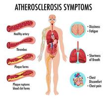 infográfico de informações sobre aterosclerose vetor