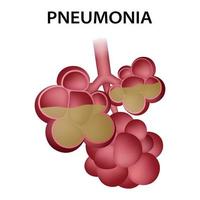 ícone de alvéolos de pneumonia, estilo realista vetor