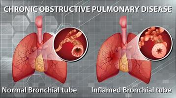 quadro de doença pulmonar obstrutiva crônica vetor