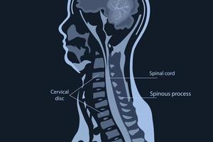 ressonância magnética da coluna cervical. espondilose e compressão medular. vetor