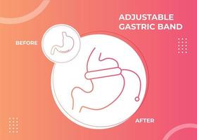 ilustração de vetor de cirurgia para perda de peso com dispositivo de banda gástrica ajustável