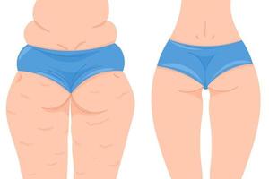 ilustração vetorial colorida antes e depois de perder peso. costas femininas com e sem celulite. nádegas femininas em uma calcinha azul vetor