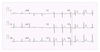 vetor de gráfico de eletrocardiograma de coração. ilustração da forma de onda no gráfico de ecg verificado. ritmo cardíaco, isquemia, infarto. pulsação vitalidade