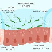 Helicobacter pylori na camada mucosa de células epiteliais inflamadas no estômago vetor