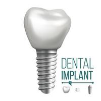 vetor de implante dentário. dentes humanos molares. folheto de estomatologia clínica odontológica. ilustração isolada realista
