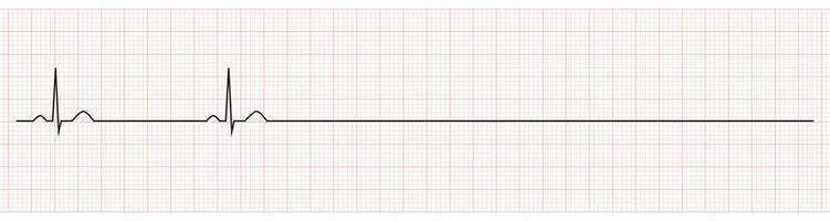 ekg mostrando bradicardia sinusal com parada do paciente vetor