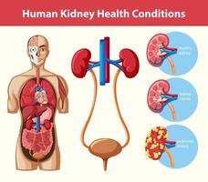 infográfico de condições de saúde de rim humano vetor