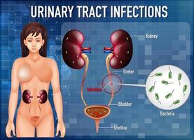 pôster de informações sobre infecções do trato urinário vetor
