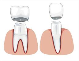 ilustração de coroa dentária, dentes saudáveis, ilustração vetorial de dentista, cuidados bucais vetor