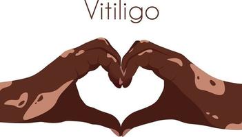 dois mãos com vitiligo remendos dentro a forma do uma coração. auto amor conceito. mundo vitiligo dia. Eu amor meu pele. Castanho pele com uma fragmento do vitiligo. pele doenças. auto Cuidado vetor