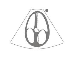 infográfico do ecocardiograma do apical cinco câmara e medição do lvot vti vetor